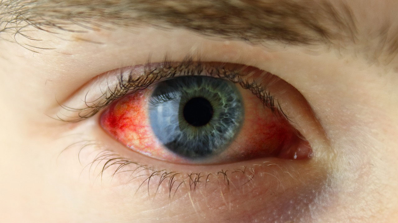 pink eye (conjunctivitis)